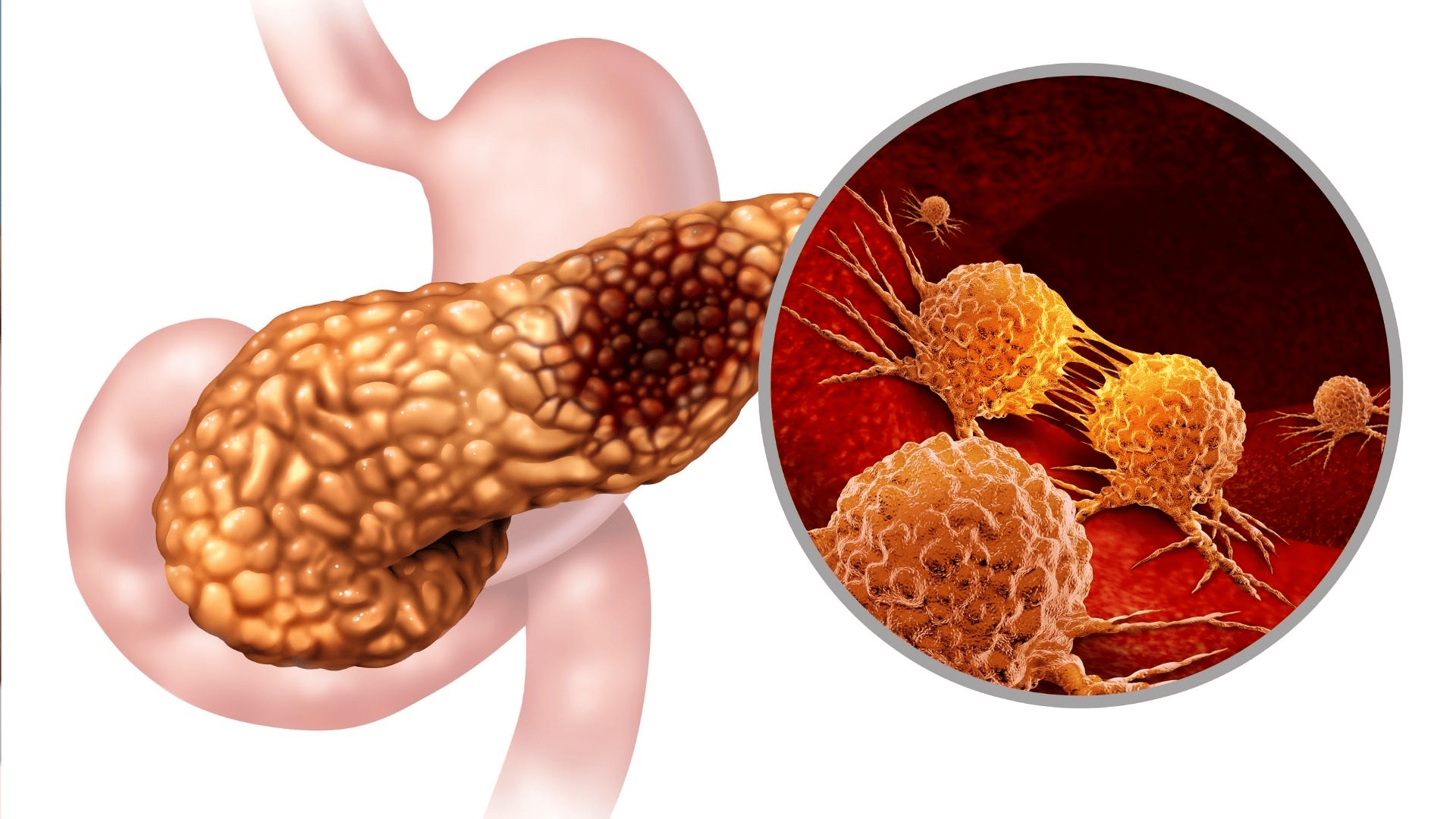 Rakovina pankreasu Ako odhaliť príznaky včasa